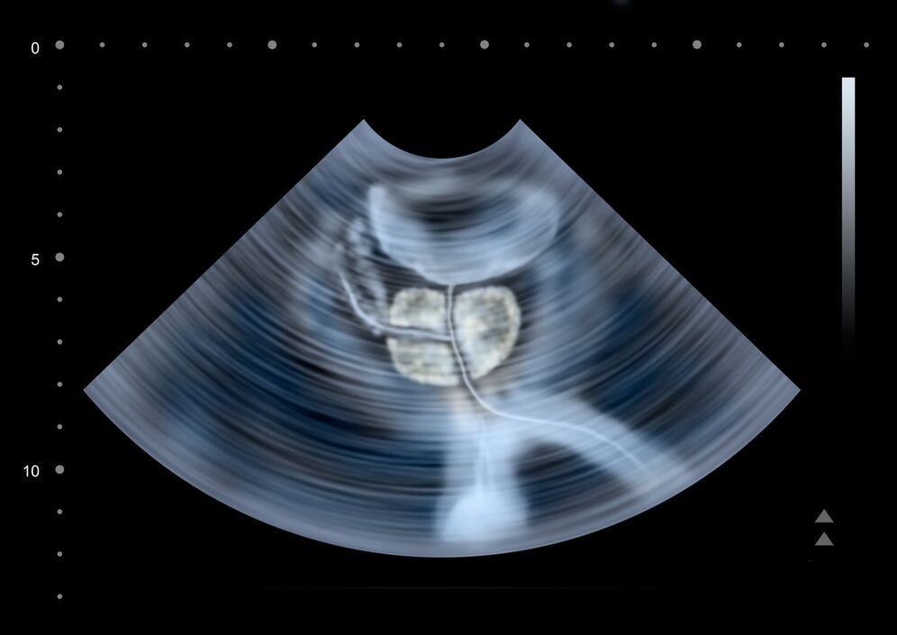 diagnostic de la prostate