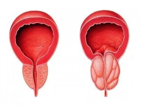 Prostate saine et enflammée